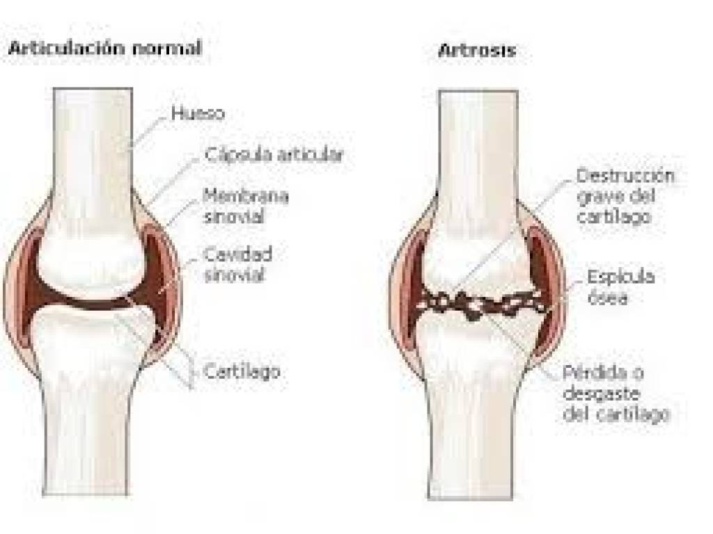 Imagen 3º parte, artrosis de rodilla Diferencias entre articulación sana y deteriorada